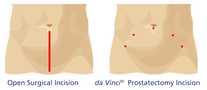 Open Surgical Incision vs. Da Vinci Prostatectomy Incision