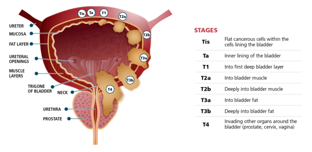 Bladder Cancer And Treatment The Robotic Surgeon Domenico Savatta Md 5906