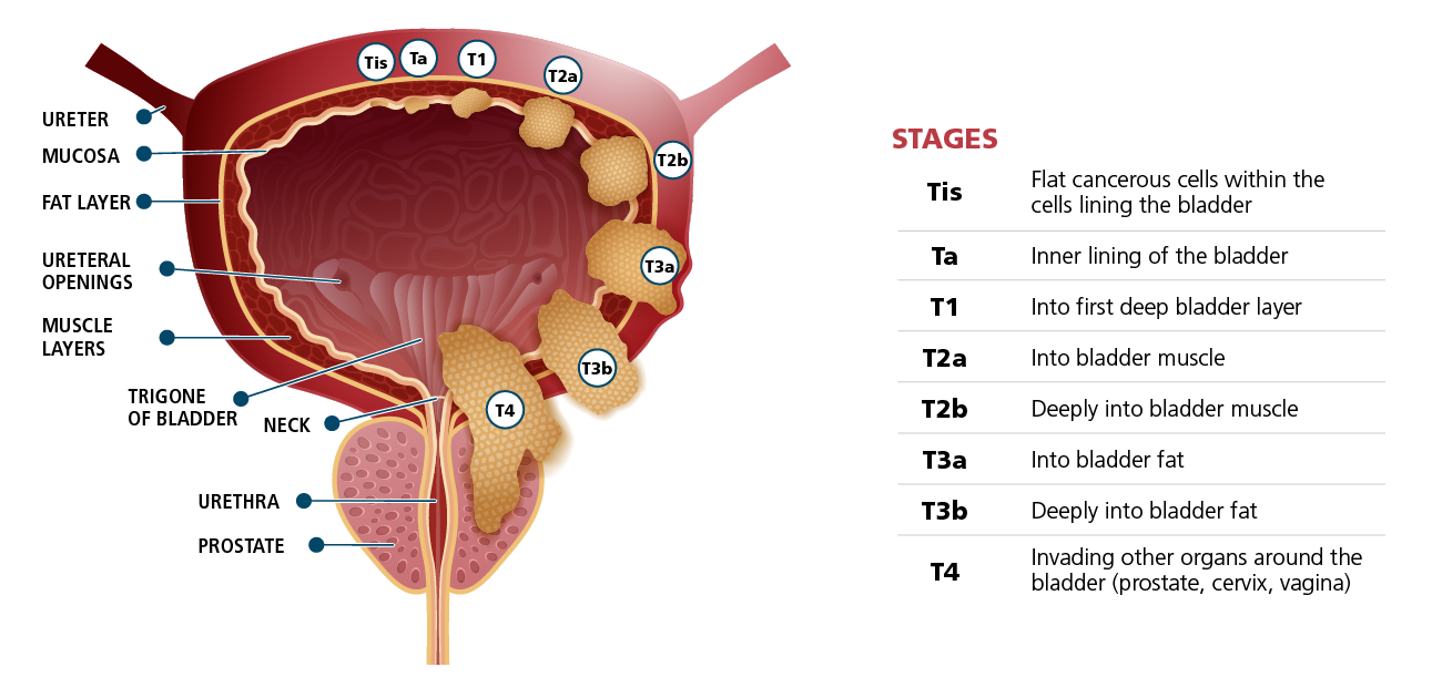 The Stages of Bladder Cancer